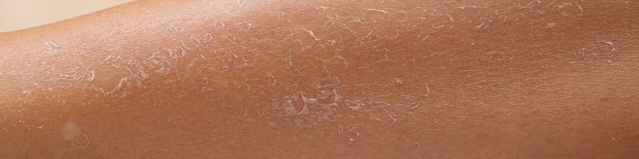 Imagem de pele descamando, sugerindo ressecamento e a necessidade de hidratação.